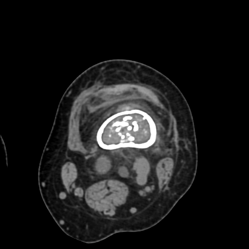 File:Chondrosarcoma - femur (Radiopaedia 64187-72954 Axial non-contrast 28).jpg