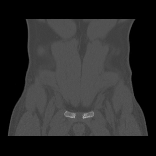 Chondrosarcoma of iliac wing (Radiopaedia 63861-72599 Coronal bone window 27).jpg