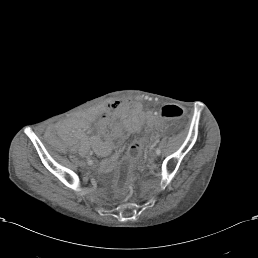 File:Chondrosarcoma of the spine (Radiopaedia 49871-55143 A 51).jpg