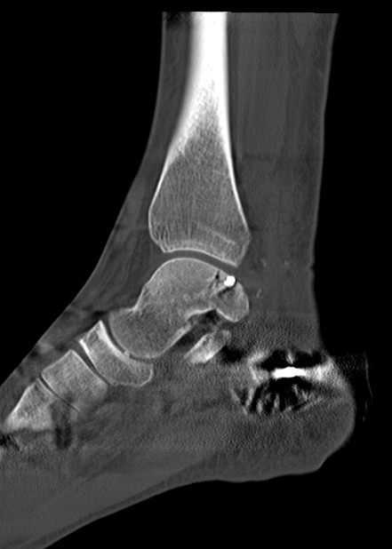 Chopart fracture (Radiopaedia 35347-36861 Sagittal bone window 37).jpg