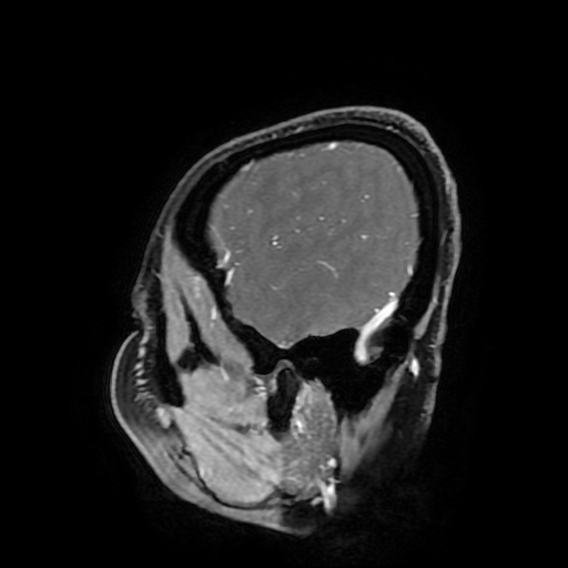File:Chordoid glioma of third ventricle (Radiopaedia 91612-109340 F 174).jpg