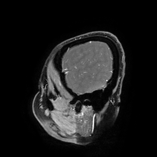 Chordoid glioma of third ventricle (Radiopaedia 91612-109340 F 178).jpg