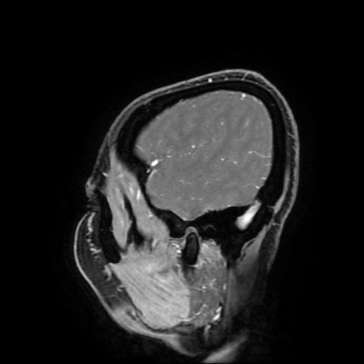 File:Chordoid glioma of third ventricle (Radiopaedia 91612-109340 F 40).jpg