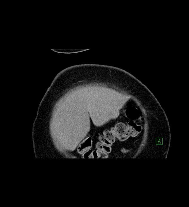 Chromophobe renal cell carcinoma (Radiopaedia 84239-99519 C 9).jpg