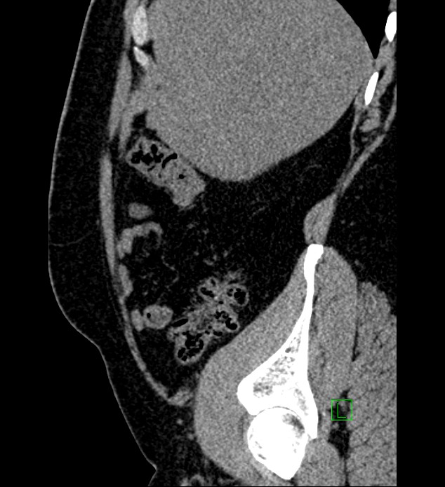 Chromophobe renal cell carcinoma (Radiopaedia 84286-99573 C 149).jpg