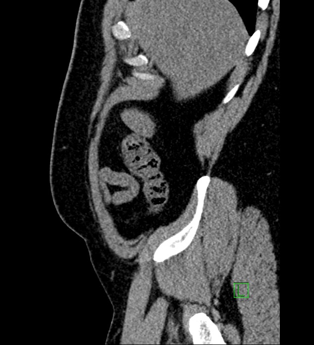 Chromophobe renal cell carcinoma (Radiopaedia 84286-99573 C 167).jpg