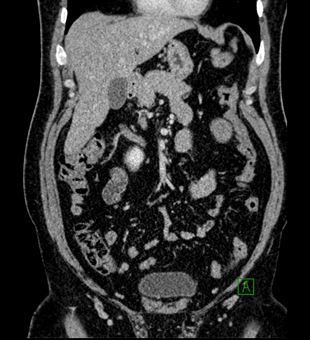 Chromophobe renal cell carcinoma (Radiopaedia 84286-99573 H 62).jpg
