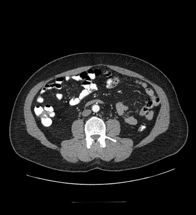 Chromophobe renal cell carcinoma (Radiopaedia 84337-99644 B 60).jpg