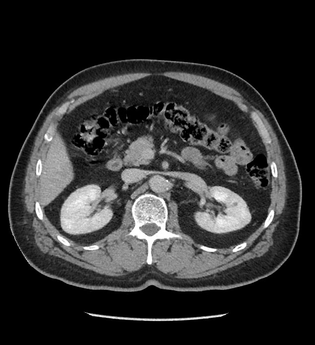 Chromophobe renal cell carcinoma (Radiopaedia 86879-103083 C 53).jpg