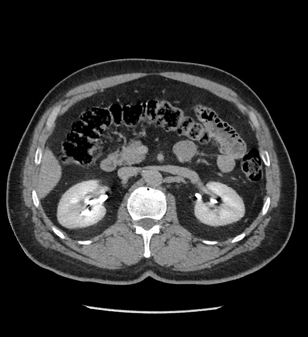 Chromophobe renal cell carcinoma (Radiopaedia 86879-103083 D 55).jpg