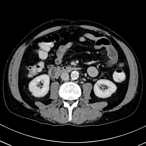 Chronic appendicitis complicated by appendicular abscess, pylephlebitis and liver abscess (Radiopaedia 54483-60700 B 79).jpg