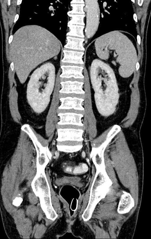 Chronic appendicitis complicated by appendicular abscess, pylephlebitis and liver abscess (Radiopaedia 54483-60700 C 56).jpg