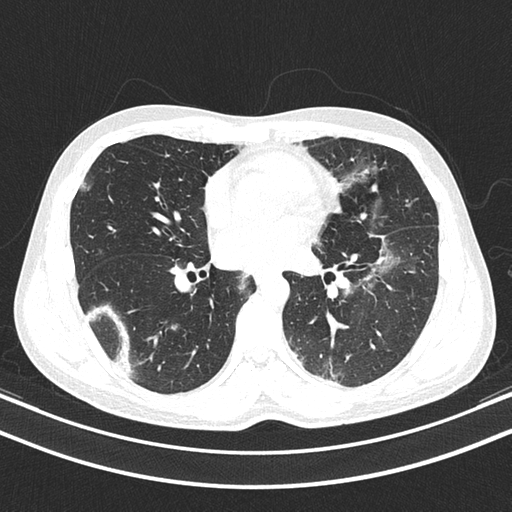 Chronic eosinophilic pneumonia (Radiopaedia 39331-41587 Axial lung window 29).png