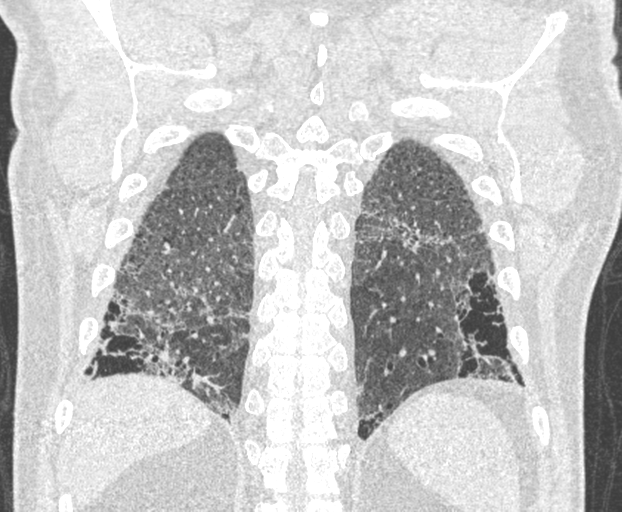 File:Chronic hypersensitivity pneumonitis (Radiopaedia 48107-52922 Coronal lung window 22).png