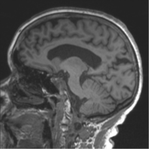 Chronic hypertensive encephalopathy (Radiopaedia 39993-42482 Sagittal T1 54).png