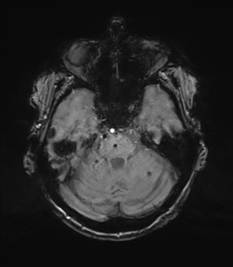 Chronic hypertensive encephalopathy (Radiopaedia 72844-83495 Axial SWI magnitude 24).png