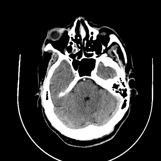 File:Chronic invasive fungal sinusitis (Radiopaedia 91563-109286 B 27).jpg