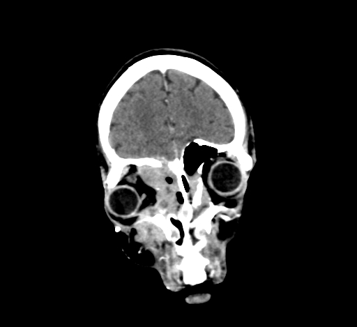 Chronic invasive fungal sinusitis with intraorbital and intracranial extension (Radiopaedia 56387-63046 C 75).jpg
