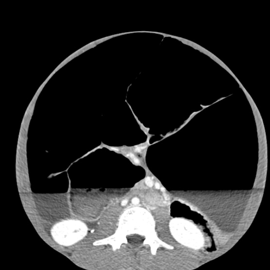 Chronic large bowel pseudo-obstruction (Radiopaedia 43181-46492 A 98).jpg