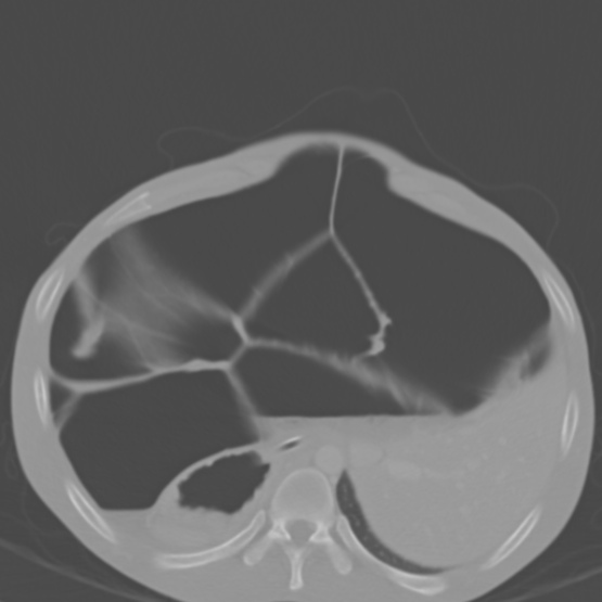 Chronic large bowel pseudo-obstruction (Radiopaedia 43181-46492 Axial bone window 47).jpg