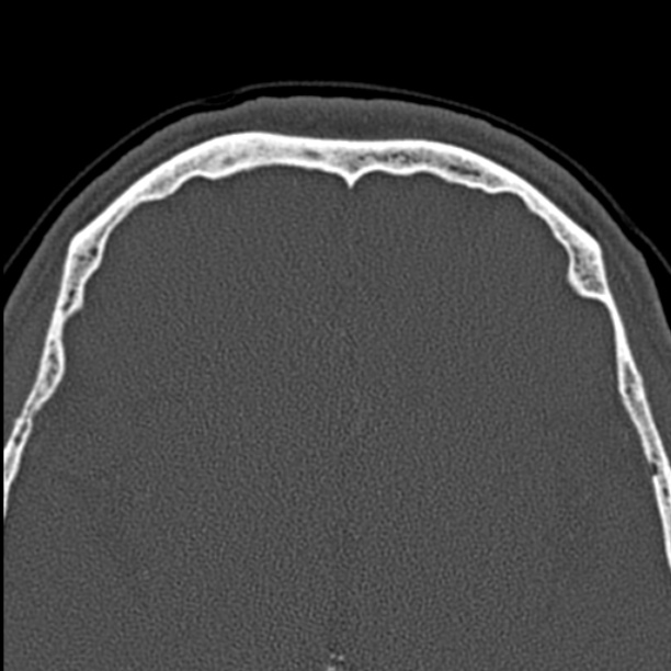 Chronic maxillary sinusitis (Radiopaedia 27879-28116 Axial bone window 53).jpg