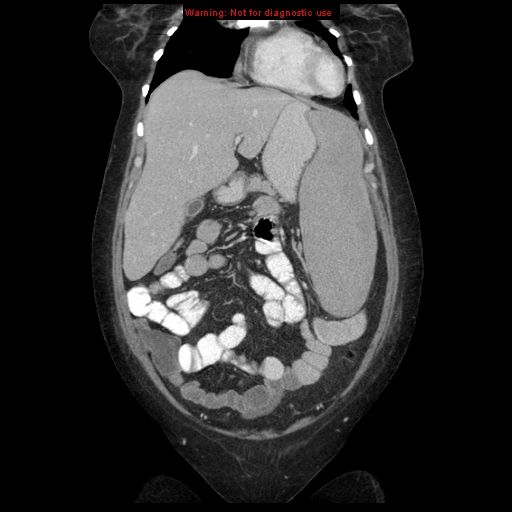 File:Chronic myeloid leukemia with splenic infarction (Radiopaedia 9178-9874 E 10).jpg