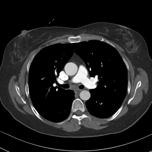 Chronic pulmonary embolus (Radiopaedia 39129-41341 Axial C+ CTPA 45).png