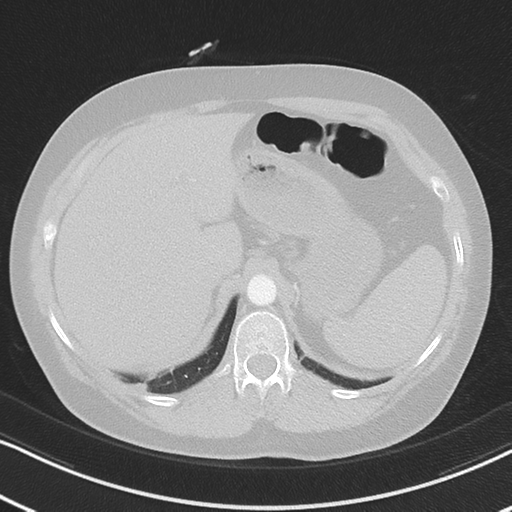 Chronic pulmonary embolus (Radiopaedia 39129-41341 Axial lung window 58).png