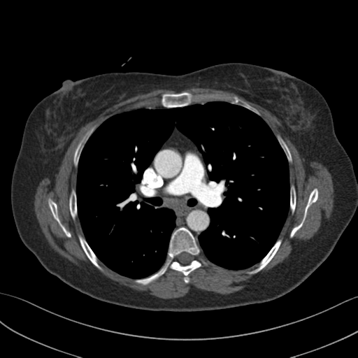 Chronic pulmonary embolus (Radiopaedia 39129-41341 Coronal C+ CTPA 1).png