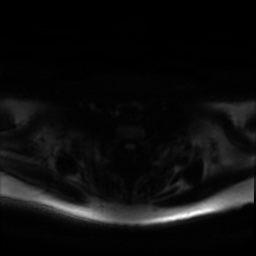 Chronic submandibular sialadenitis (Radiopaedia 61852-69885 Axial DWI 27).jpg