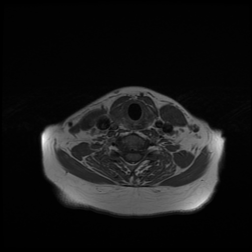 File:Chronic submandibular sialadenitis (Radiopaedia 61852-69885 Axial T1 23).jpg