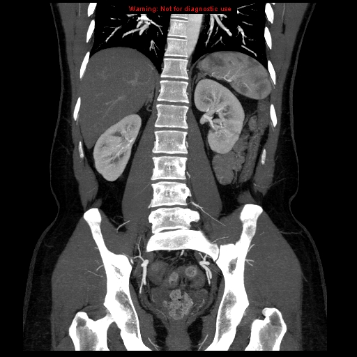 File:Circumaortic left renal vein (Radiopaedia 9069-9792 B 27).jpg