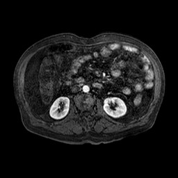 Cirrhosis and hepatocellular carcinoma in the setting of hemochromatosis (Radiopaedia 75394-86594 Axial T1 C+ fat sat 101).jpg