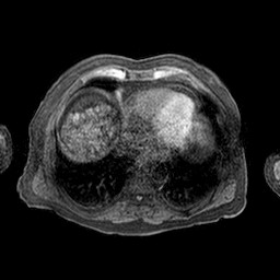 Cirrhosis and hepatocellular carcinoma in the setting of hemochromatosis (Radiopaedia 75394-86594 Axial T1 C+ fat sat 75).jpg