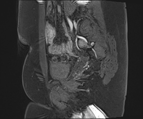 File:Class II Mullerian duct anomaly- unicornuate uterus with rudimentary horn and non-communicating cavity (Radiopaedia 39441-41755 G 28).jpg