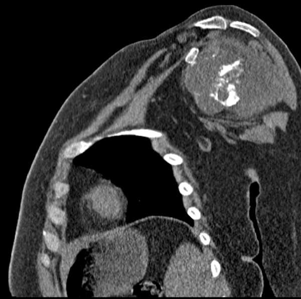 Clear cell chondrosarcoma - humerus (Radiopaedia 63104-71612 D 33).jpg