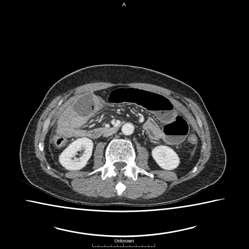 Closed loop bowel obstruction and ischemia (Radiopaedia 86959-103180 A 36).jpg