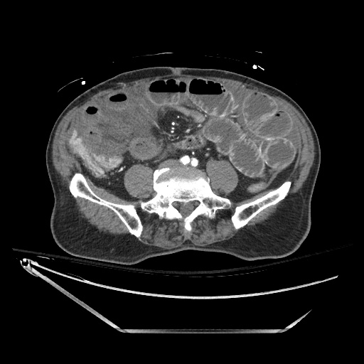 Closed loop obstruction due to adhesive band, resulting in small bowel ischemia and resection (Radiopaedia 83835-99023 B 97).jpg