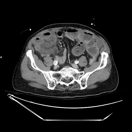 Closed loop obstruction due to adhesive band, resulting in small bowel ischemia and resection (Radiopaedia 83835-99023 D 111).jpg