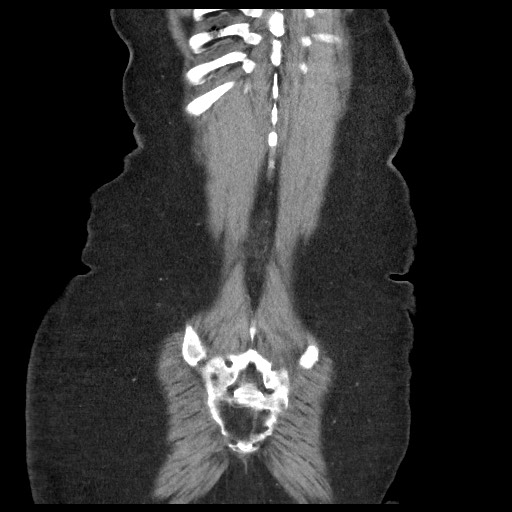 Closed loop small bowel obstruction - internal hernia (Radiopaedia 65402-74450 B 98).jpg