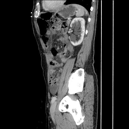 Closed loop small bowel obstruction - omental adhesion causing "internal hernia" (Radiopaedia 85129-100682 C 127).jpg