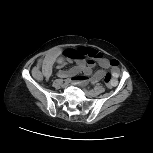 Closed loop small bowel obstruction due to adhesive band, with intramural hemorrhage and ischemia (Radiopaedia 83831-99017 Axial non-contrast 110).jpg