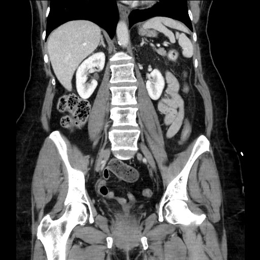 Closed loop small bowel obstruction due to adhesive bands - early and late images (Radiopaedia 83830-99014 B 76).jpg