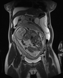 File:Closed loop small bowel obstruction in pregnancy (MRI) (Radiopaedia 87637-104031 Coronal T2 23).jpg