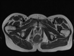 Closed loop small bowel obstruction in pregnancy (MRI) (Radiopaedia 87637-104031 D 42).jpg