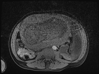 Closed loop small bowel obstruction in pregnancy (MRI) (Radiopaedia 87637-104031 F 6).jpg