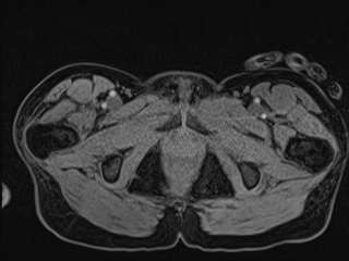 File:Closed loop small bowel obstruction in pregnancy (MRI) (Radiopaedia 87637-104031 G 32).jpg
