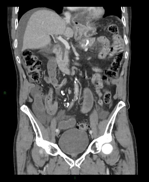 File:Closed loop small bowel obstruction with ischemia (Radiopaedia 84180-99456 B 36).jpg