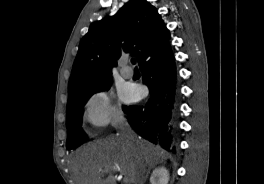Coarctation of aorta with aortic valve stenosis (Radiopaedia 70463-80574 B 5).jpg