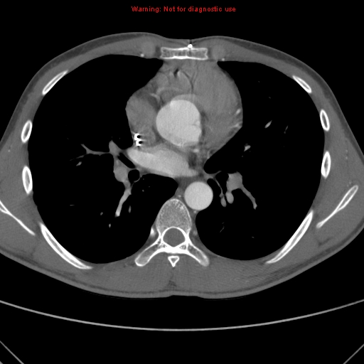 File:Coarctation of the aorta (Radiopaedia 9434-10118 A 97).jpg